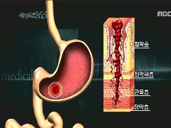 100세 건강 닥터스 9회