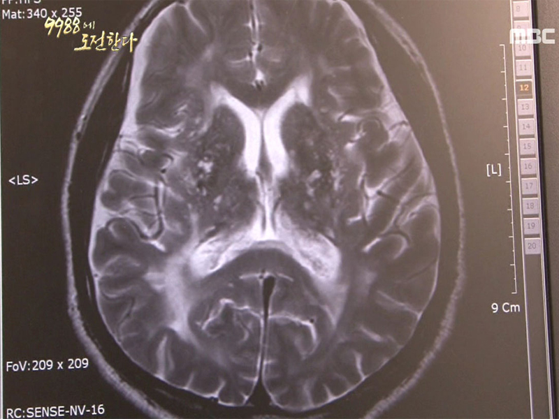 건강프로젝트 9988에 도전한다 “침묵의 질병, 고혈압“