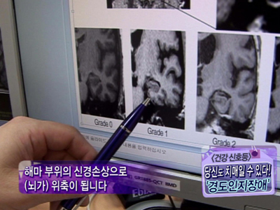 [건강신호등] 당신도 치매일 수 있다! - 경도인지장애 클립 이미지