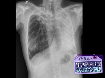 [건강4U] 콜록콜록 기침, 방치했다간 사망?! 만성폐쇄성폐질환! 클립 이미지