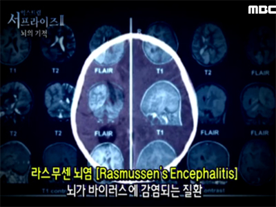 Extreme SurpriseⅡ. 뇌의 기적 클립 이미지