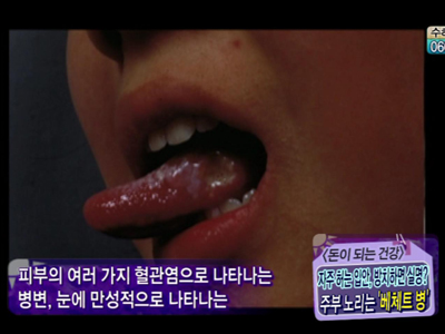 [돈이되는건강] 여름 주부 건강 비상! 자주 허는 입안!  클립 이미지