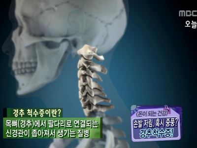 [돈이 되는 건강] 여름철 손발저림, 혹시 중풍? 경추 척수증! 클립 이미지