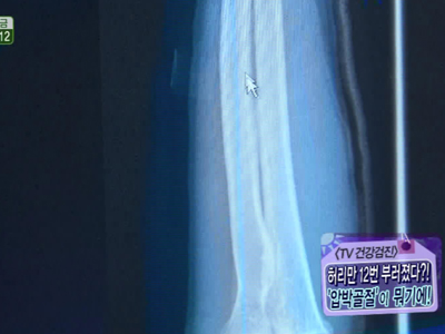 [TV건강검진] ‘콜록’ 기침 한 번에 허리가? ‘압박골절’ 주의보!  클립 이미지