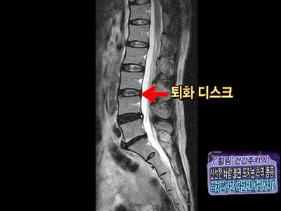 [힐링 건강주치의] 선선한 가을만 되면 도지는 허리! 방치했다간 하반신 마비까지!