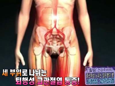 [‘힐링’ 건강주치의] 중년여성 노리는 앉은뱅이 병! 퇴행성 고관절염 클립 이미지