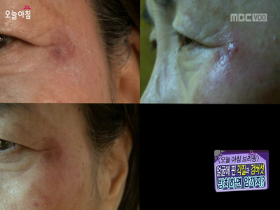 얼굴에 핀 각질과 검버섯, 방치하면 암까지?! 클립 이미지