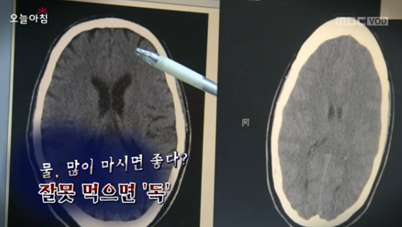 [알고계십니까?] 물, 많이 마시면 좋다? 잘못 먹으면'독'
