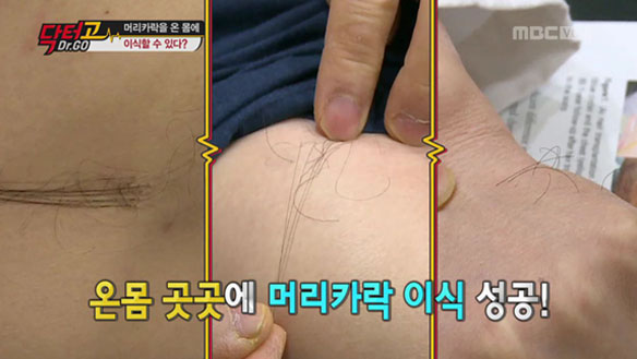 겨드랑이털도 머리에 이식할 수 있다? "옮겨진 부위에 따라 모발 성질 바뀐다"