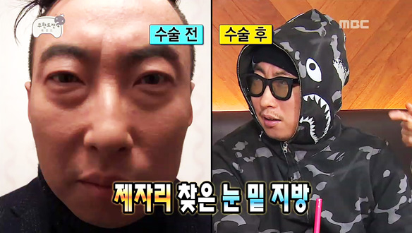 3주 사이 회춘한 박명수, 눈 밑 지방 재배치 시술 협찬 의혹 해명 "100퍼센트 돈 내고" 클립 이미지